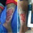 Difference between arterial and venous ulcer showing key wound characteristics