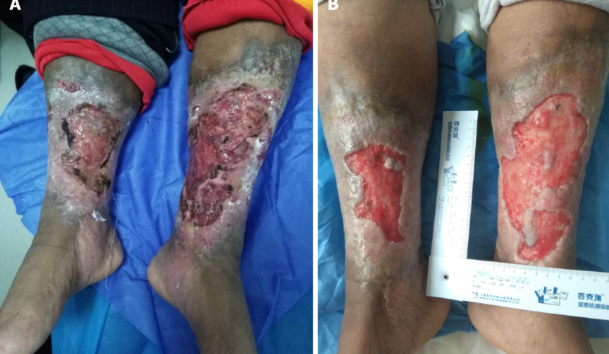 Difference Between Arterial and Venous Ulcer Difference between arterial and venous ulcer showing key wound characteristics