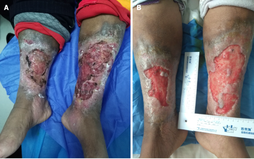 Difference Between Arterial and Venous Ulcer Difference between arterial and venous ulcer showing key wound characteristics