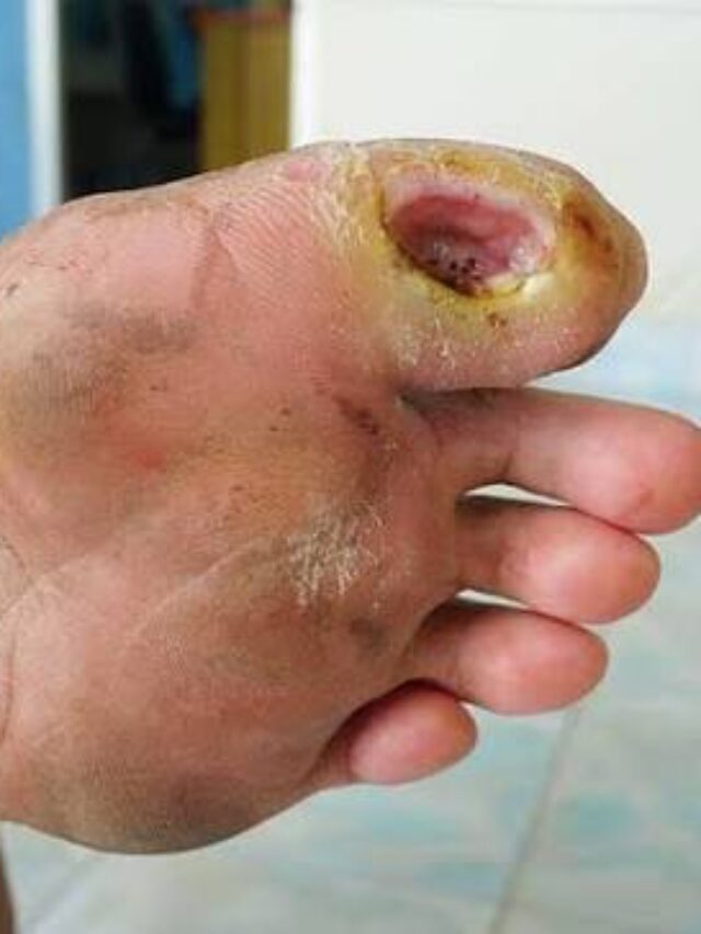 Diabetic Foot Infection: Symptoms, Causes, Treatment & Prevention