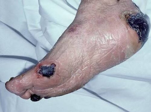 Eschar on wound with signs of possible infection