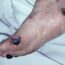 Eschar on wound with signs of possible infection