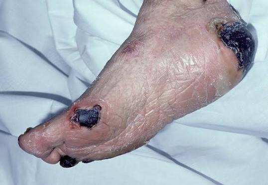 Signs of Infection in an Eschar-Covered Wound Eschar on wound with signs of possible infection