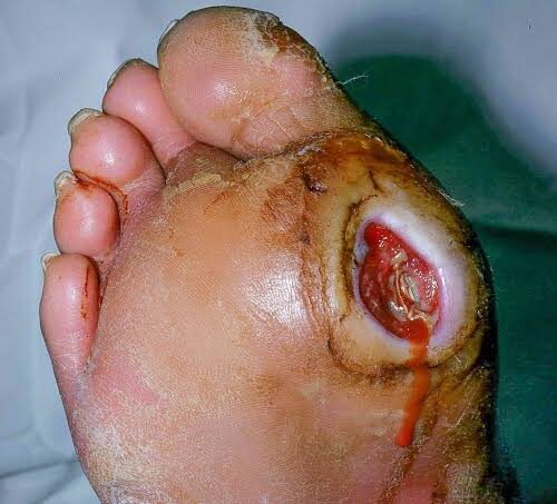 Diabetic foot ulcer treatment and wound care