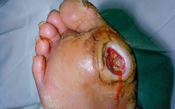 Diabetic foot ulcer treatment and wound care