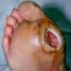 Diabetic foot ulcer treatment and wound care