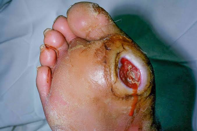 Diabetic foot ulcer treatment Diabetic foot ulcer treatment and wound care