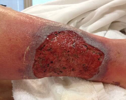 Non-Healing Ulcer wound care