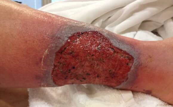 Non-Healing Ulcer wound care