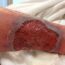 Non-Healing Ulcer wound care
