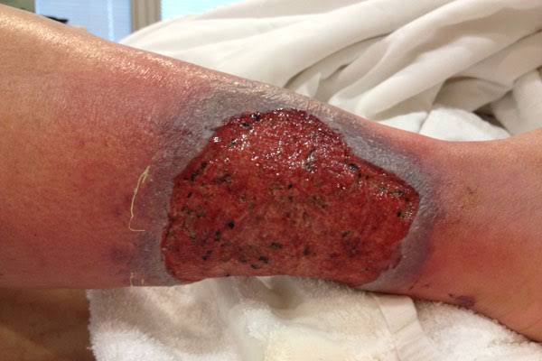 Non-Healing Ulcer – Causes and Wound Healing Non-Healing Ulcer wound care