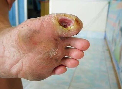Diabetic Foot Infection symptoms including redness, swelling and wound drainage