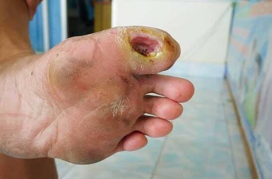 Diabetic Foot Infection symptoms including redness, swelling and wound drainage