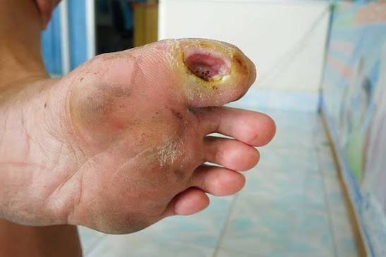 Diabetic Foot Infection Symptoms and Treatment Diabetic Foot Infection symptoms including redness, swelling and wound drainage