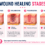 Four Wound Healing Stages from injury to tissue repair and scar maturation