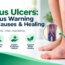 Venous ulcers showing warning signs, causes and healing treatment options