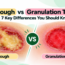 Slough vs Granulation Tissue showing yellow slough compared with healthy pink red granulation tissue