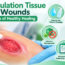 Granulation Tissue in Wounds showing healthy healing tissue, wound cleaning and key wound care steps